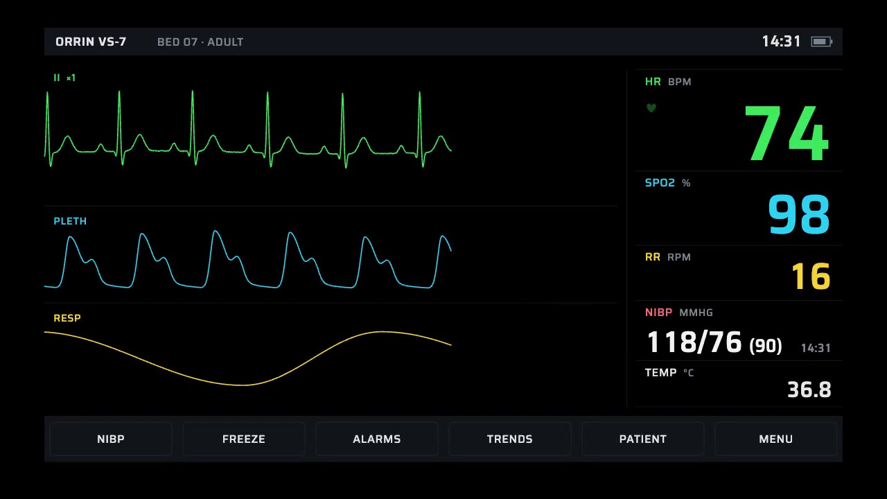 Vital Signs Monitor: charts animation made with Claude